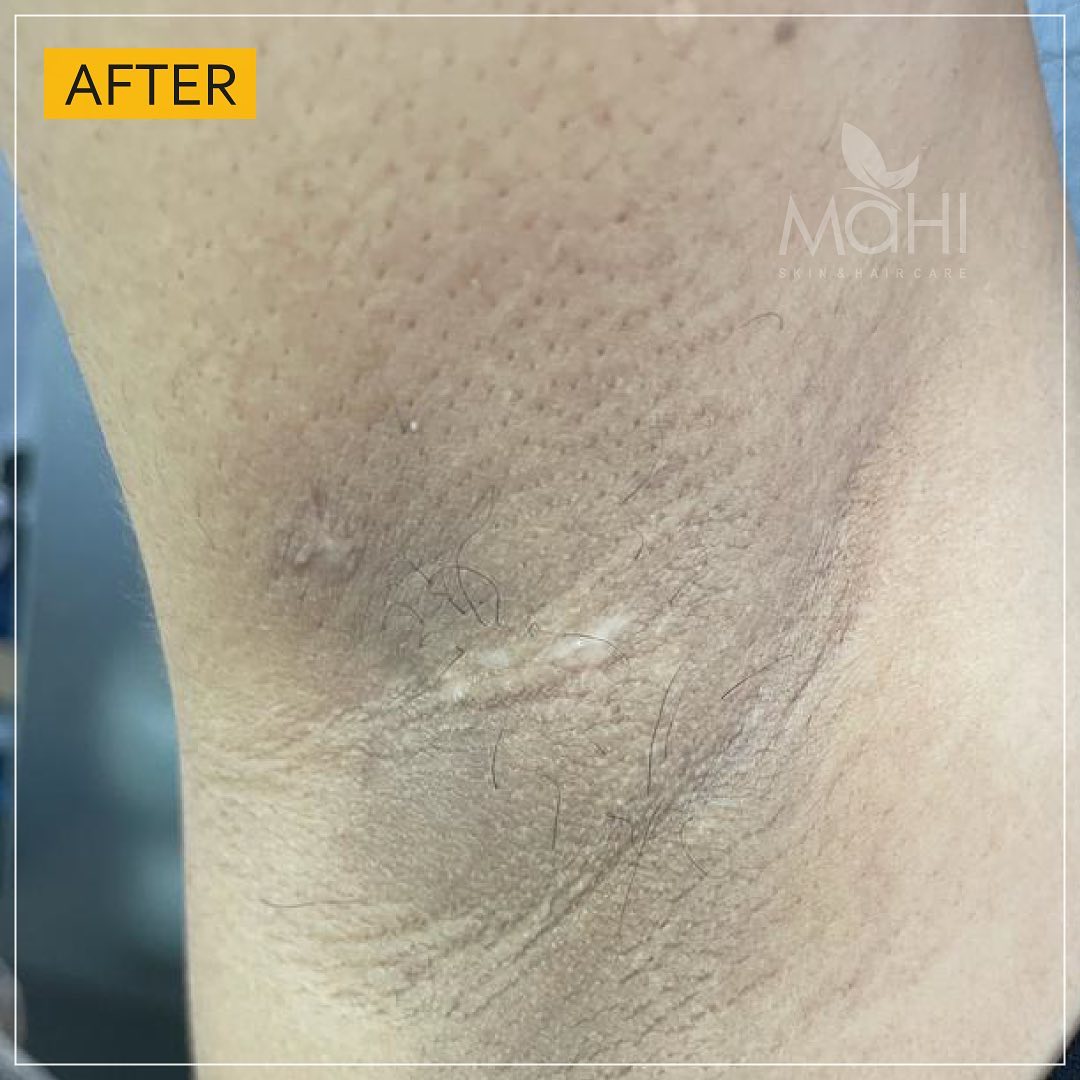 Underarms laser hair reduction after 6 sessions Mahi Skin Clinic Chennai