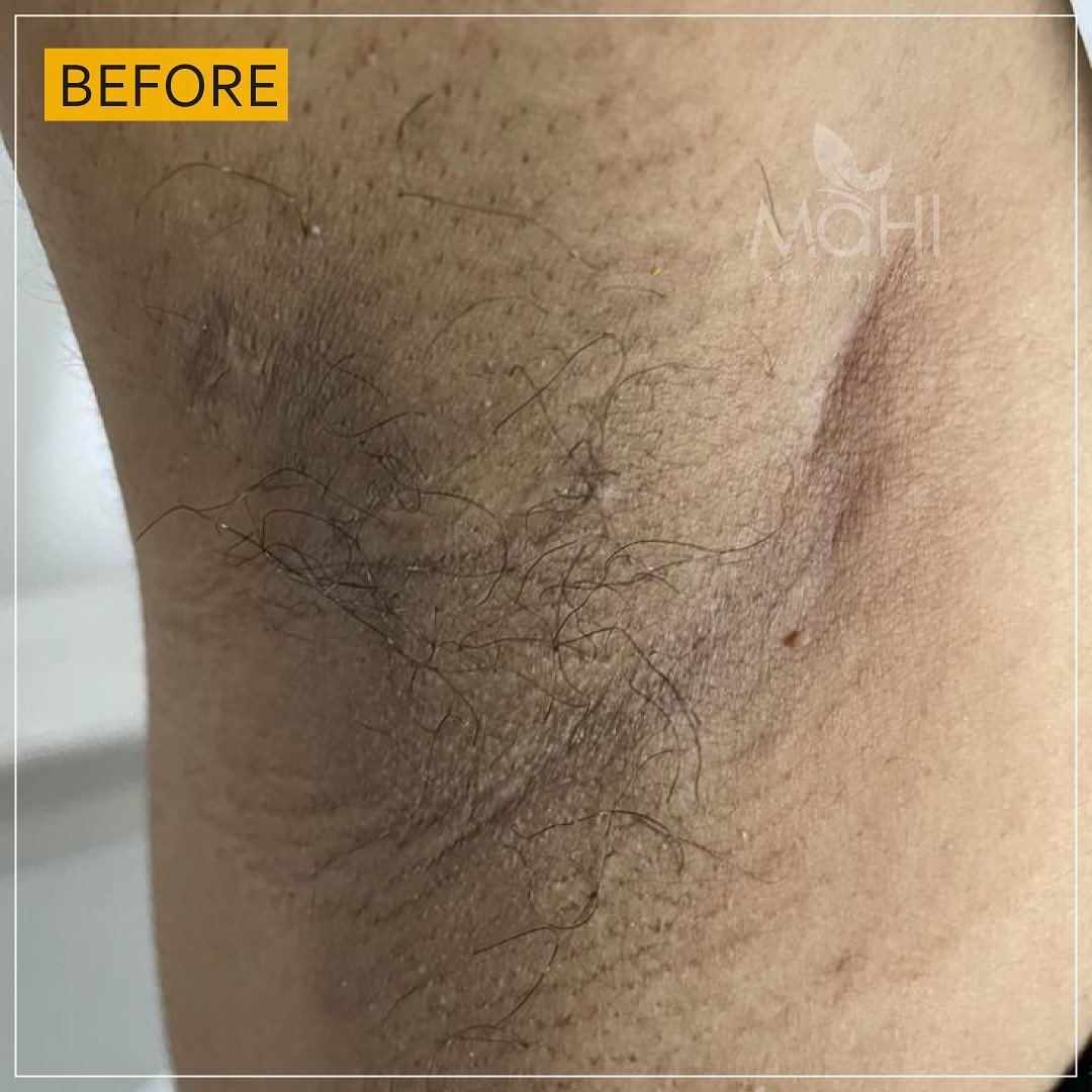 Underarms laser hair reduction before treatment Mahi Skin Clinic Chennai